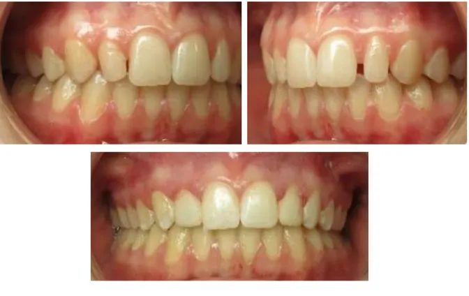 Figure 7 : Agénésie d'une incisive latérale associée à une microdontie des prémolaires 