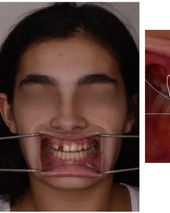 Figure 8 : Les dents sont alignées, le patient ne nécessite qu'un traitement prothétique et non  orthodontique
