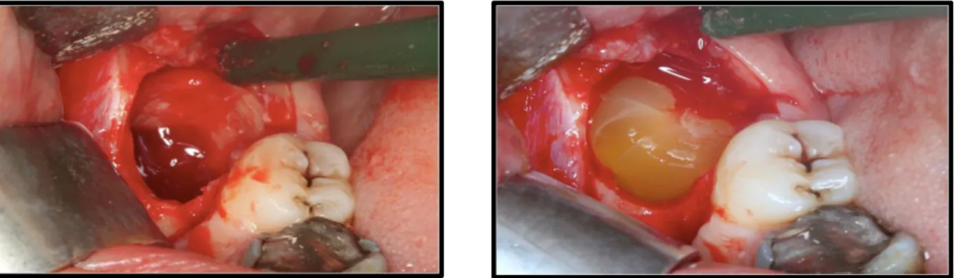 Figure 7 : Alvéole dentaire avec et sans caillot de L-PRF 