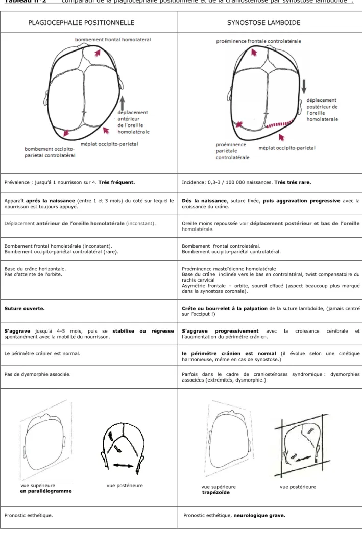 Tableau n°2       comparatif de la plagiocéphalie positionnelle et de la craniosténose par synostose lambdoïde  :           