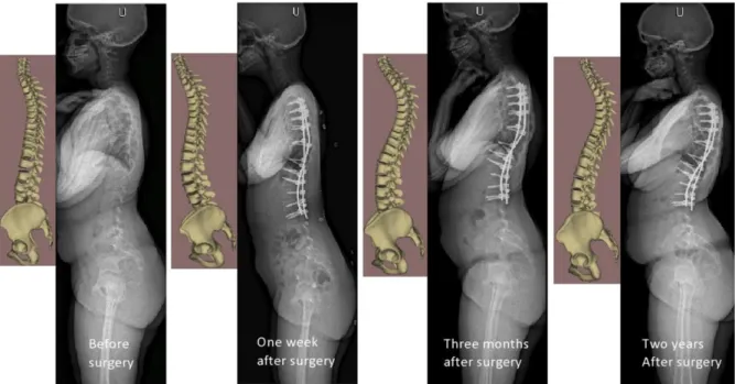 Fig. 6. The evolution of a patient with adolescent idiopathic scoliosis before and after surgery