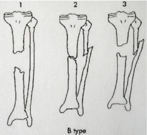 Figure 1 : Classification de Paley et Catagni sur les PSO segmentaires supérieures à 1cm  (3) :  