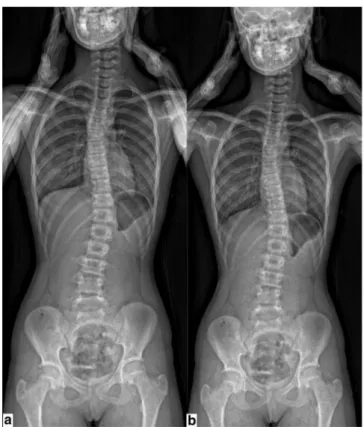Fig. 3 a Coronal full-spine image in EOS scanner  using  micro-dose  protocol.  b  Coronal  full-spine  image  in  EOS  scanner  using  reduced  micro-dose  protocol 