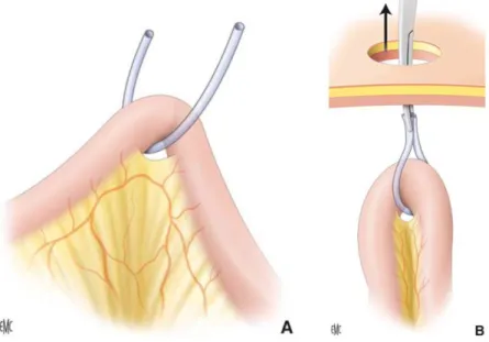 Figure 7 : Passage du lacs au travers de l'orifice mésentérique (A), Pince tractant le lacs au 