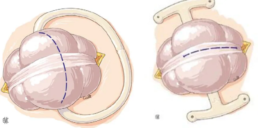 Figure 8 : Ouverture de la colostomie par incision transversale (à gauche) ou longitudinale (à  droite) (Thibaudeau et al