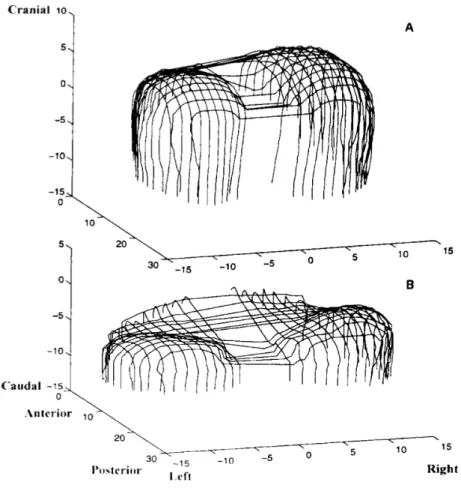 Figure 7. Reconstruction tridimensionnelle d'une vue latérale gauche postéro-supérieure du  diaphragme chez un patient sain (A) et un patient souffrant de BPCO (B)