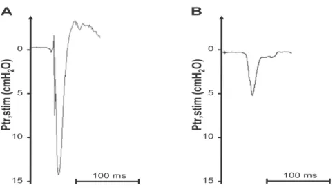 Figure 10. Mesure de la P tr  par stimulation phrénique bilatérale. 
