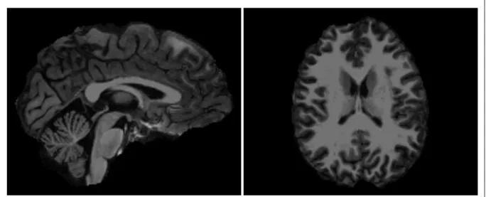 Figure 2.4 Vues sagittale et axiale du cerveau provenant du participant E043            (survivant) après la segmentation dans FreeSurfer 
