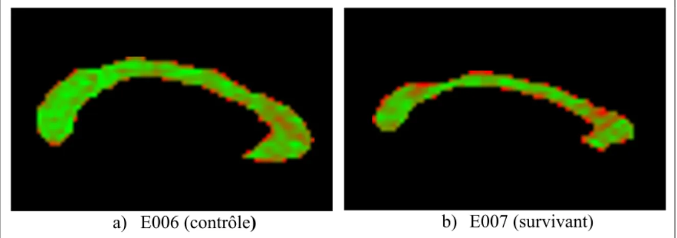 Figure 2.10 Vue sagittale du corps calleux segmenté des participants E006 et E007              avec une interpolation rouge-vert sur les intensités de MTR 