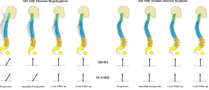 Figure 3.  The schematic diagram on the evolution of changes in the global sagittal profiles of AIS patients with  and without thoracic hypokyphosis pre-operative and at different time points post-operative