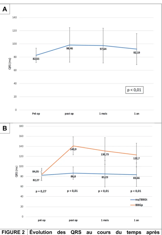 FIGURE 2 Évolution des QRS au cours du temps après  remplacement valvulaire aortique INTUITY