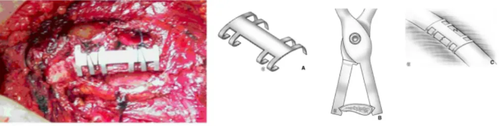 Figure de gauche : Bemelman M, Poeze M, Blokhuis TJ, Leenen LPH. Historic overview of treatment techniques for rib fractures and  flail chest