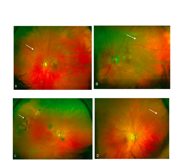 Figure 1: Color photos illustrating peripheral fundus abnormalities   A: Photography illustrating hard drusen