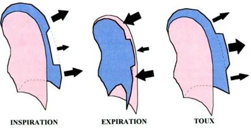 Figure 2. Description schématique d’une respiration paradoxale sur volet costal 