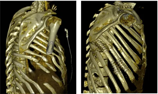 Figure 6. Volet costal avant et après ostéosynthèse, vue scannographique 