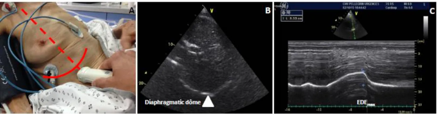 Figure 8. Principes de mesure de l'excursion diaphragmatique droite en expiration forcée (EDE max )  A) Sonde cardiaque positionnée au niveau de la ligne médio claviculaire et la ligne axillaire antérieure en sous  costale, le patient étant demis assis