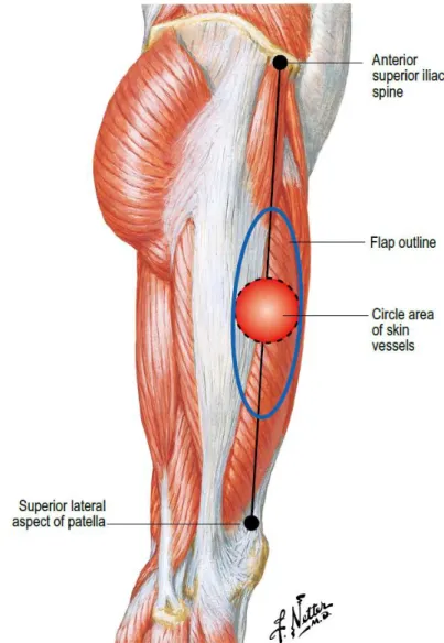 Figure 1.10 : Dessin du lambeau. Flaps and reconstructive surgery, 2009, Wei, Mardini.
