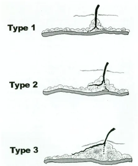 Figure 1.11. Trois types de perforantes dans la graisse profonde selon Kimura.