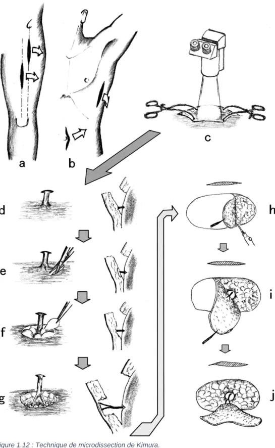 Figure 1.12 : Technique de microdissection de Kimura.