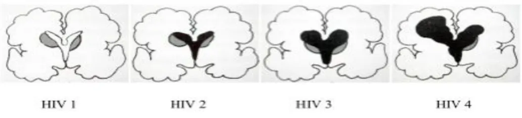 Figure 1. Classification de Papile [10]. En noir sont représentées les lésions hémorragiques, en gris les  ventricules latéraux