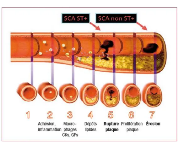 Figure 1 : Evolution de la maladie athéromateuse 