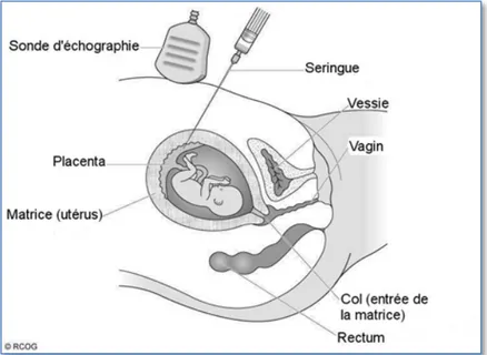Figure   6   :   Placentocentèse   par   voie   transabdominale                                                      