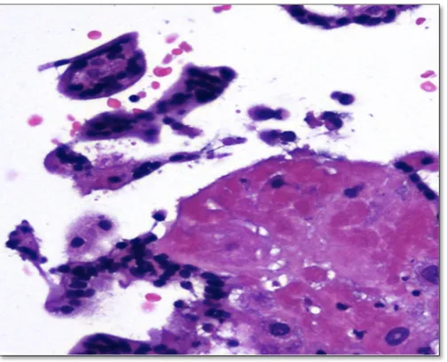 Figure   9   :   Biopsie   de   villosités   choriales.Chorio-­‐amniotite.   