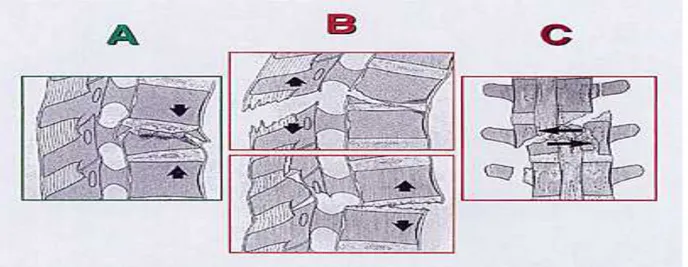 Figure 9 : Les 3 types de fractures vertébrales selon la classification de Magerl 