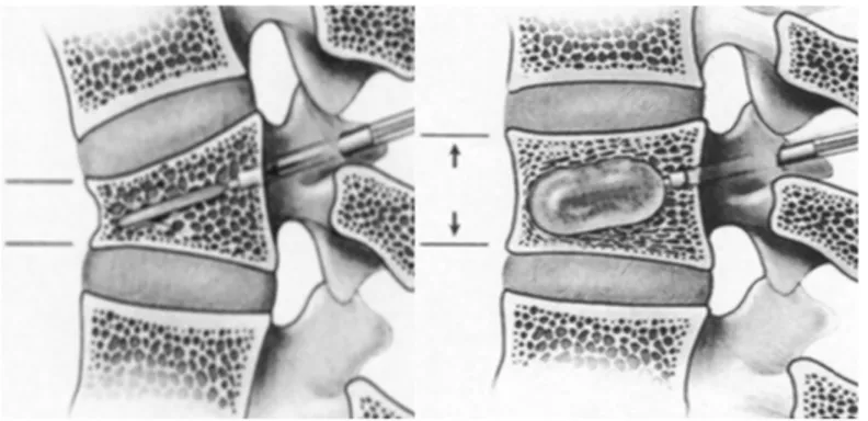 Figure 13 : Technique de la kyphoplastie 
