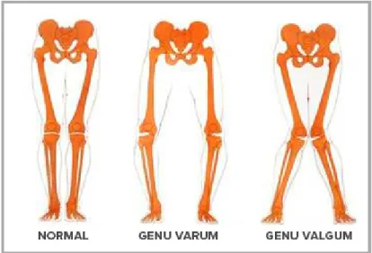 Figure 1.4 Genou en varus / valgus   Reproduite avec l’autorisation d’EMOVI Inc. 