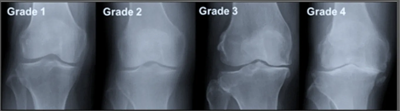Figure 1.7 Les 4 grades d’avancée de l’arthrose tirée de Woo Nam (2015, p.1) 
