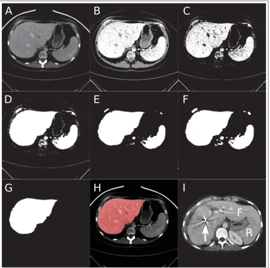 Figure 3.1 Exemple de segmentation par morphologie et classiﬁcation sur une image TDM de foie