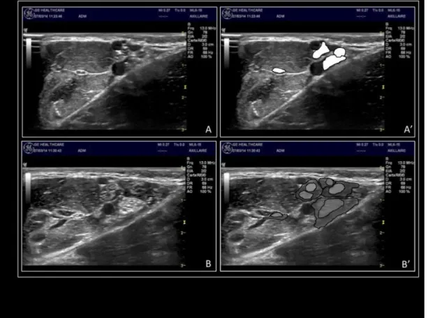 Figure n° 15 : Images échographiques de la fosse axillaire avant (A et A’) et après (B et B’) injection  en sous-paraneural (nerfs et flaques d’anesthésique local en surimpression sur les coupes A’ et B’)