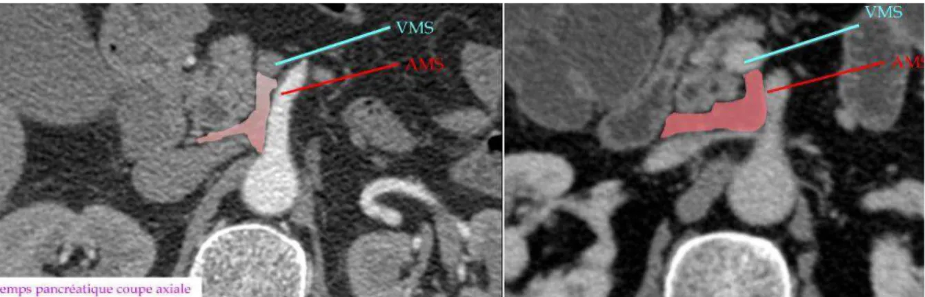 Figure 4 : scanner abdominal avec injection de produit de contraste au temps pancréatique :  la lame rétro-porte (M