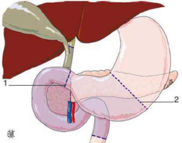 Figure 10 : la DPC emporte la tête du pancréas, le cadre duodénal et la voie biliaire  principale (Source EMC)