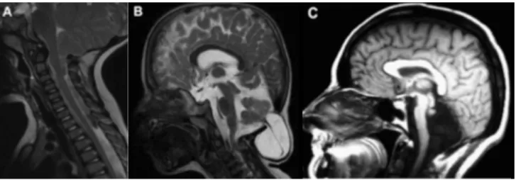 Figure 2 : Classification des malformations de Chiari 