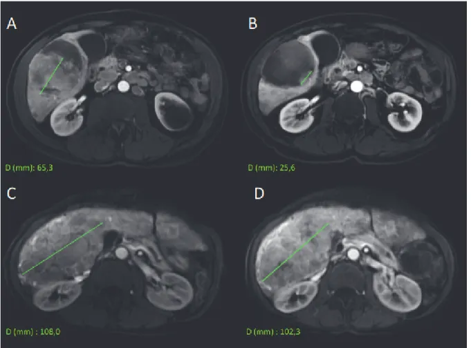 FIGURE  1  : Evaluation of tumor response according to mRECIST criteria on the T1-weighted  gradient-echo imaging in arterial phase before and after TACE
