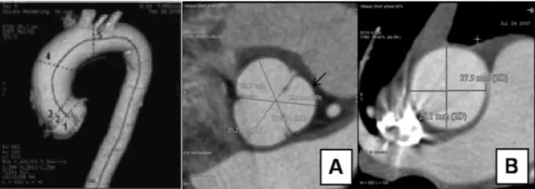 Figure 3 : Mesures des diamètres aortiques au scanner (17) 
