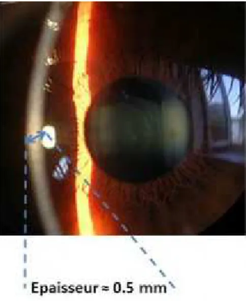 Figure 1: Observation de la cornée à la lampe a fente. 