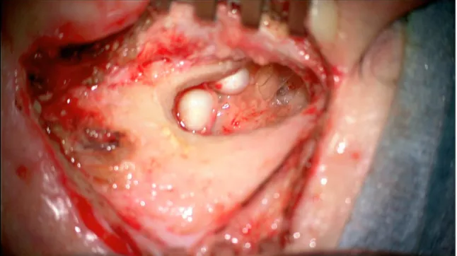 Fig1 : image per opératoire avec 2 perles de cholestéatome au sein de la cavité  d’antro mastoidectomie