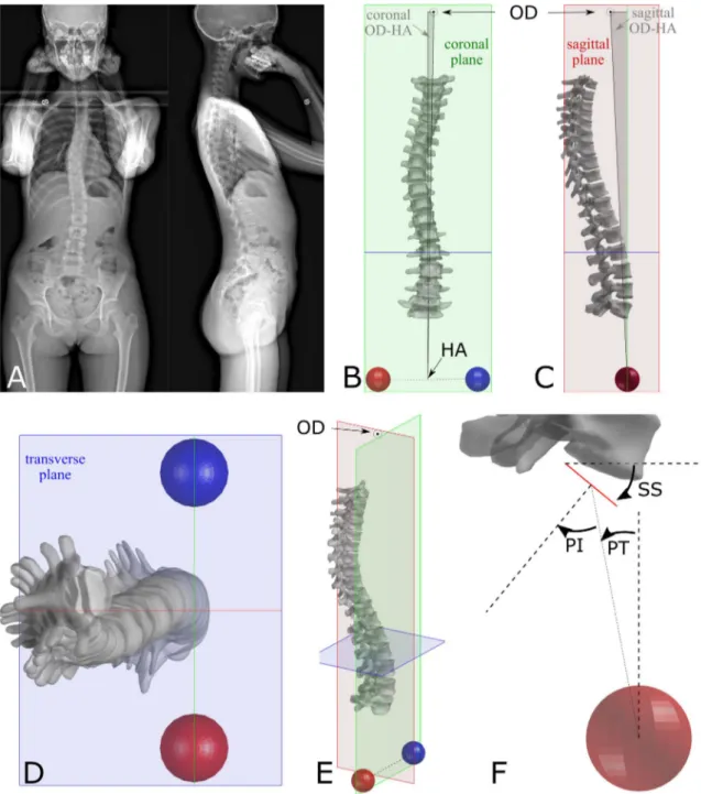 Fig. 1    Biplanar radiographs of an adolescent idiopathic scoliotic  patient (a) and 3D reconstruction of the pelvis, spine and C2 odontoid  process (OD) in frontal (b), sagittal (c), top (d) and 3D views