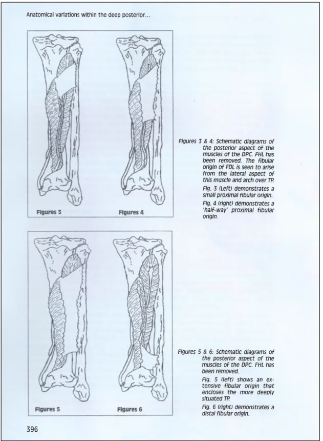 Figure  3  :  Variations  anatomiques  du  long  fléchisseur  des  orteils  (FDL) ;  relations  entre  son  insertion fibulaire et le tibial postérieur (TP) au sein de la loge postérieure profonde 67 