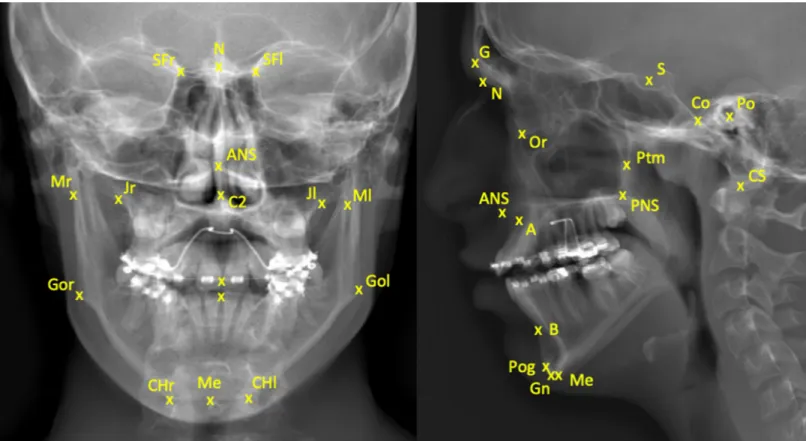 Fig 4. Posteroanterior and lateral images of a patient without hands in front of the face, using the biplanar low-dose X-ray imaging system