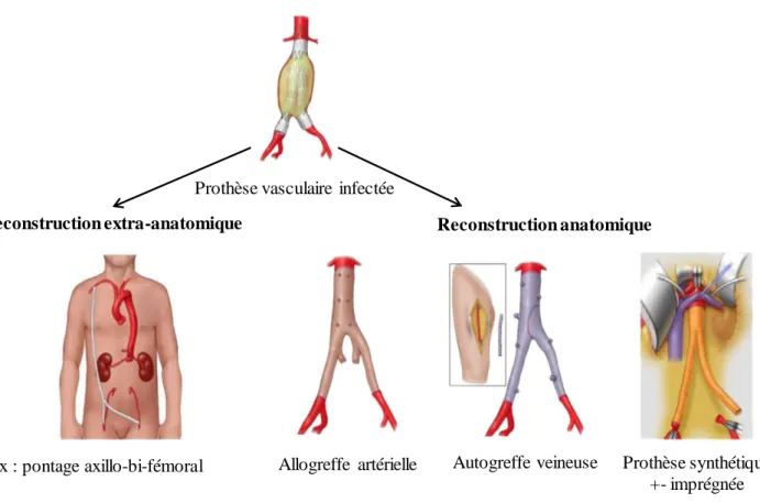 Figure 3 : Les différentes modalités de reconstruction vasculaire  après dépose d’une prothèse infectée, d’après  Smeds et al