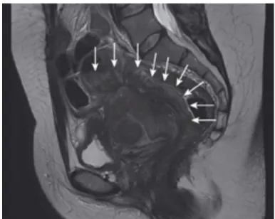 Figure    8   :    coupe    IRM    TSE   T2,    montrant    une    atteinte    endométriosique    extensive    de    la    paroi    rectosigmoïdienne   antérieure   sur   plus   de   10   cm   de   hauteur   (flèches)   (7)   