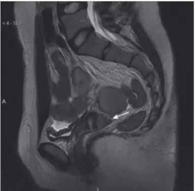 Figure    9   :    coupe    IRM    sagittale    T2    montrant    une    atteinte    endométriosique    du    cul-­‐de-­‐sac    vaginal    postérieur   sous   la   forme   d'un   épaississement   en   arrière   du   col   correspondant   à   un   nodule   