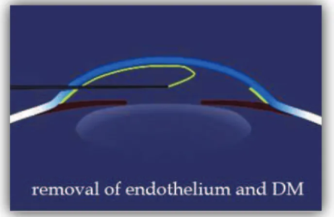 Figure n°11 : Coupe transversale d’une chambre antérieure montrant le principe du  descemetorhexis (endothélium visible en jaune) 