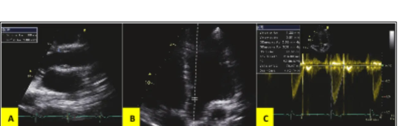 Figure 8 : Mesure du DC par doppler au décours d'une échocardiographie transthoracique GE® 