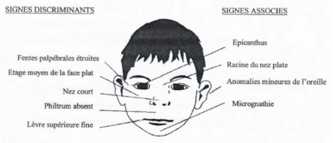 Figure 1 : Signes de la dysmorphie faciale caractéristique d’un enfant atteint de SAF [29]  