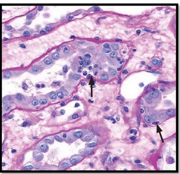 Figure 5. Infiltration de l’épithélium tubulaire par des lymphocytes (t2) (x400, PAS)